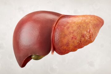 Fígado adoecido avança, muitas vezes, de forma silenciosa.